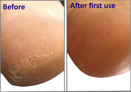НаноПятки. Unique Means for feet: removal of rough skin, cracks, calluses.